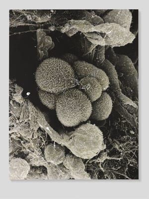 Artwork Title: Lung Cancer Scanning Electron Micrograph