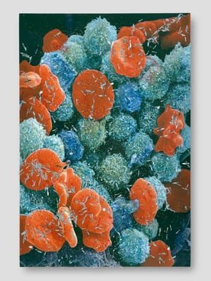 Artwork Title: Biopsy Paintings: Leukaemia Blood Cells Scanning Electron Micrograph