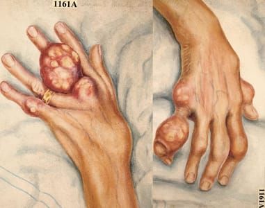 Artwork Title: Left: Watercolour drawing of the left hand of a sixty-three year old woman suffering from chronic go