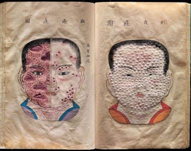 Artwork Title: Pages from The Essentials of Smallpox