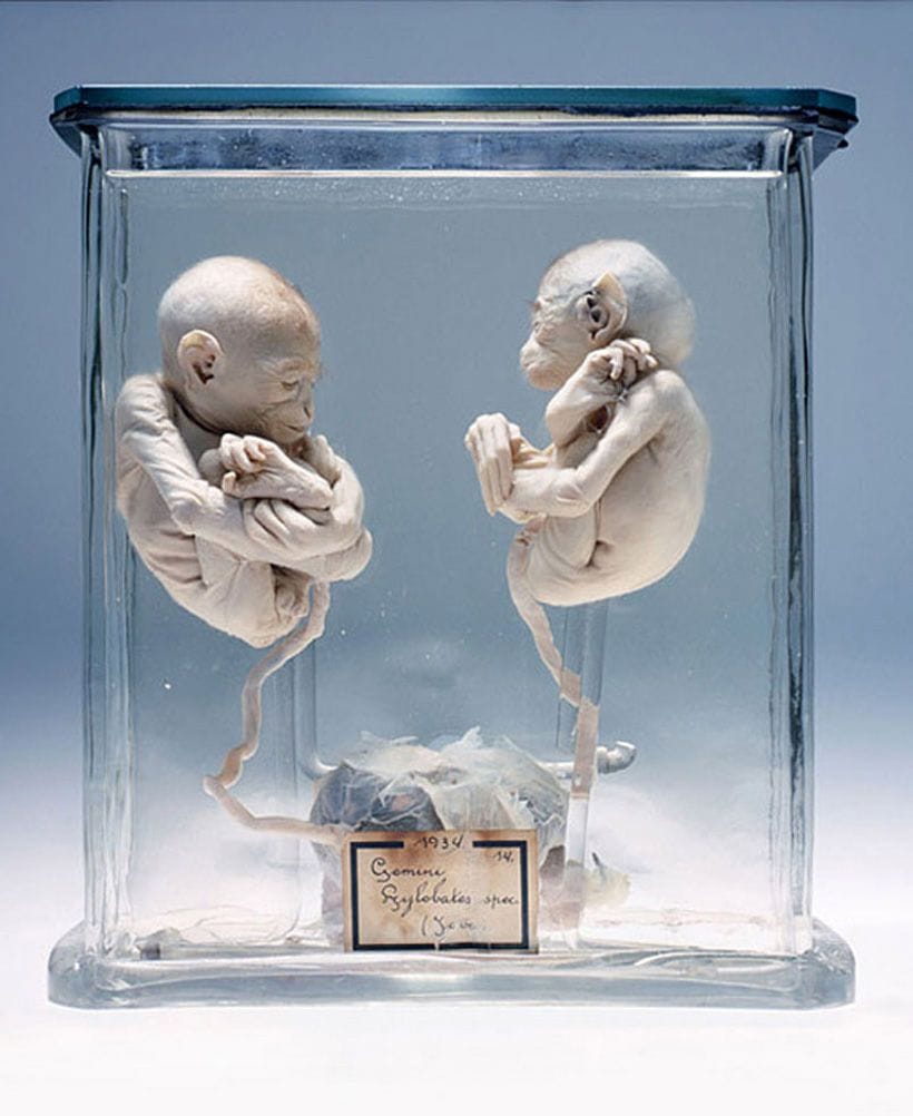 Artwork Title: Javanese monozygotic twins with umbilical cord and placenta (1934)
