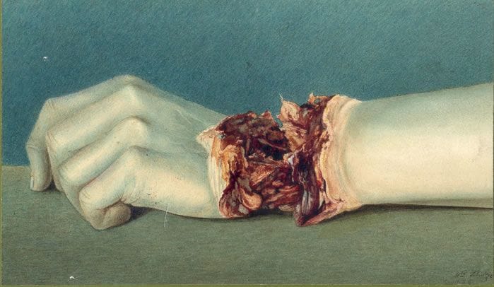 Artwork Title: Shell wound of the wrist