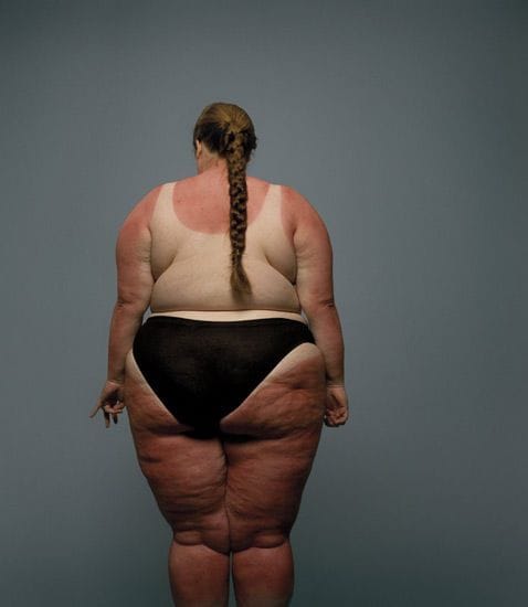 Artwork Title: Sunburn