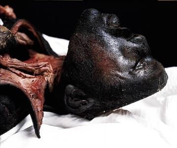 Artwork Title: The Morgue: Burn Victim