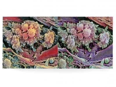 Artwork Title: Breast Cancer Cells Scanning Electron Micrograph