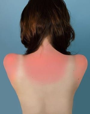 Artwork Title: Sunburn in Naples