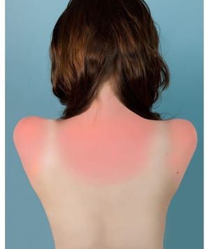 Artwork Title: Sunburn in Naples