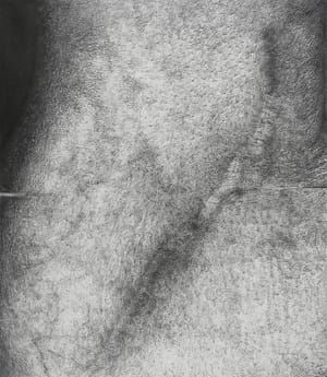 Artwork Title: Cr615N ArmScar