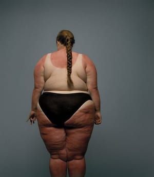 Artwork Title: Sunburn