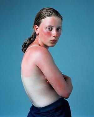 Artwork Title: Sunburnt